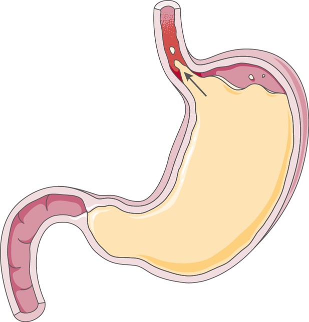 acid-reflux